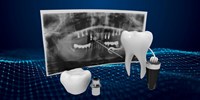ایمپلنت دندان دیجیتال چیست ؟